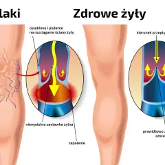 Porównanie nóg z żylakami i zdrowych. Ilustracja pokazuje, jak bieganie wpływa na żyły, zapobiegając powstawaniu żylaków.
