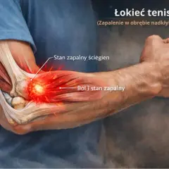 Ból łokcia po zewnętrznej stronie, zapalenie ścięgien i stan zapalny w obrębie nadkłykcia bocznego.