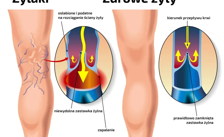 Bieganie a żylaki - Kiedy pomaga, a kiedy szkodzi?