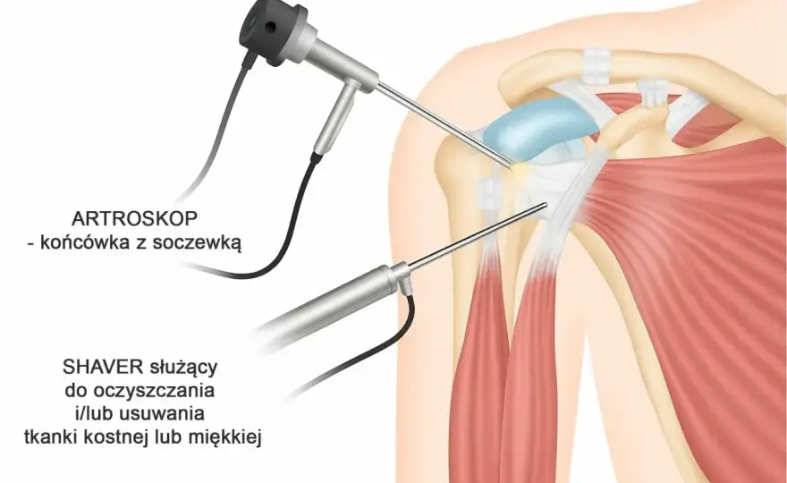 Ból ręki - przeciążenie czy coś poważniejszego?